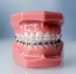 LightForce Custom 3D-Printed Braces