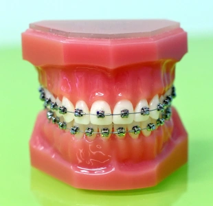 Traditional Metal Braces