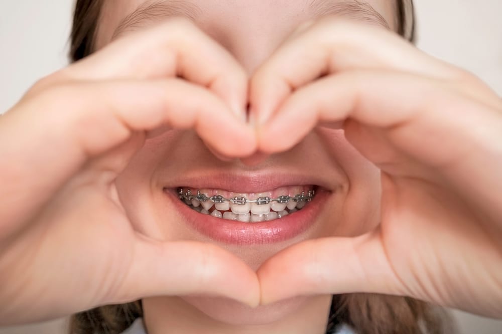 Close-Up Smile with Metal Braces and Heart Hands - Braces A close-up view of a young person smiling with metal braces as they form a heart shape with their hands around their mouth. - Braces